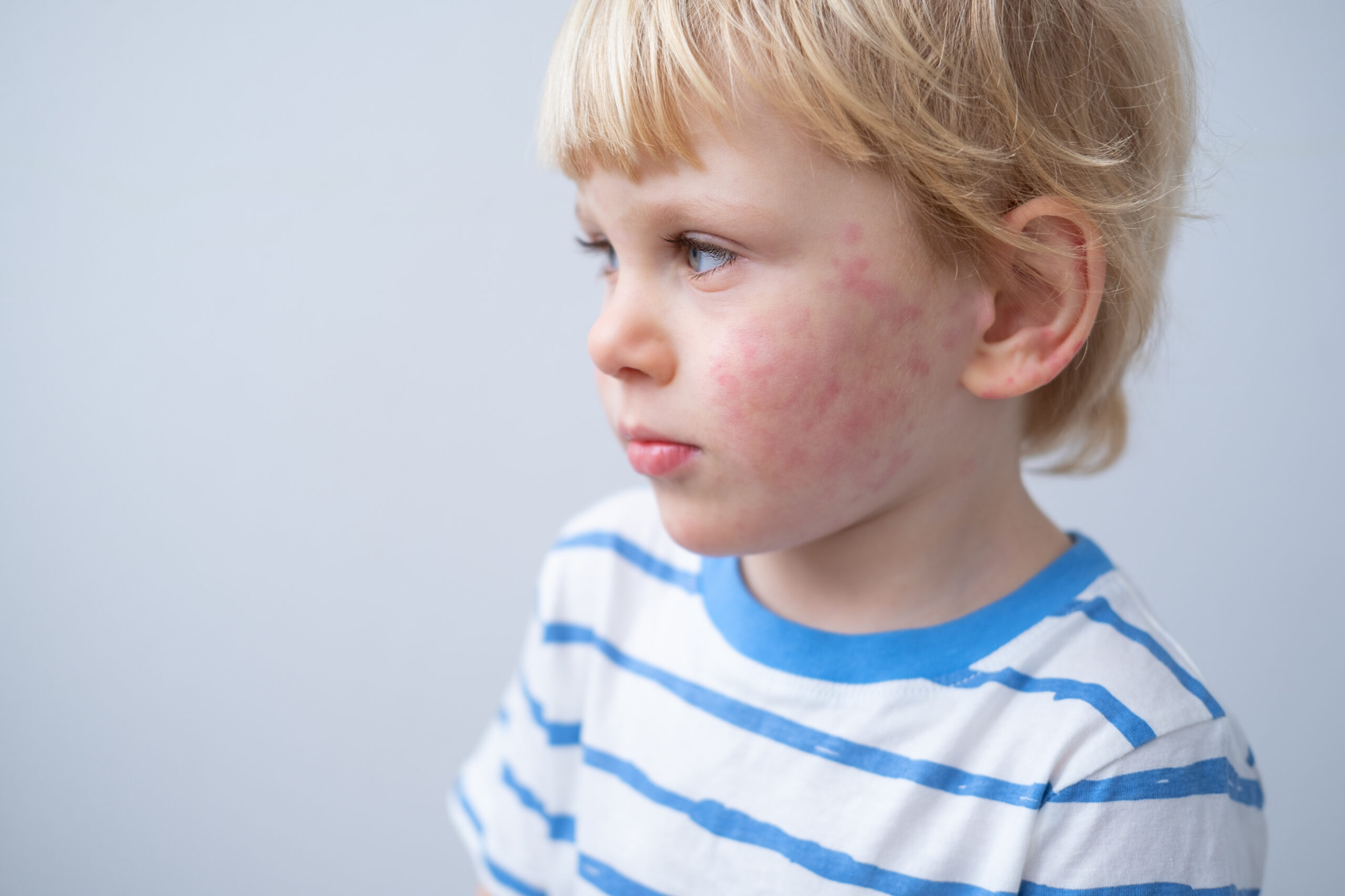 A white child faces towards the left to show a rash on his cheek. Allergy rash.